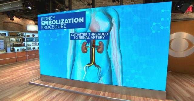 Melania Trump's kidney "embolization procedure" explained CBS News