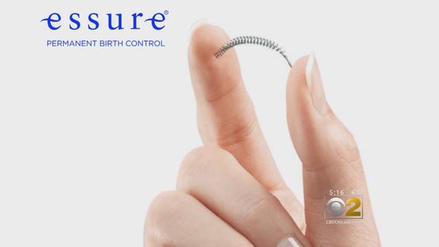 essure-birth-control.jpg 