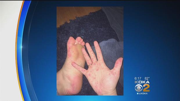 hand foot mouth disease 