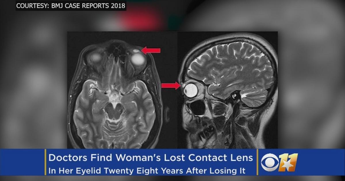 Teen Lost Contact Lens Doctors Find It In Her Eyelid 28 Years Later Cbs Minnesota