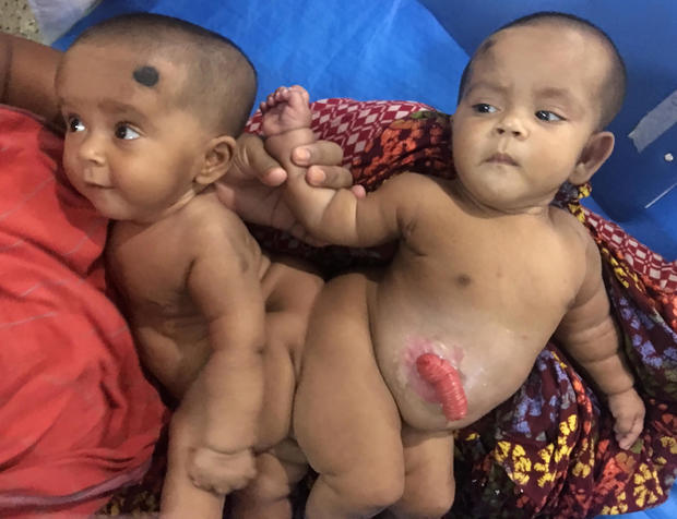 BANGLADESH-HEALTH-DOCTORS-CONJOINED-TWINS 