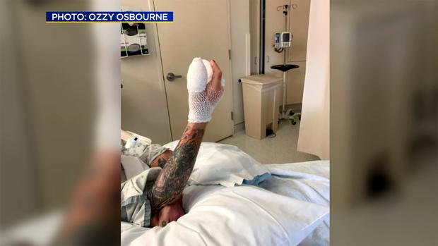 Ozzy Osbourne Tweeted a Photo of his Hand After Surgery 