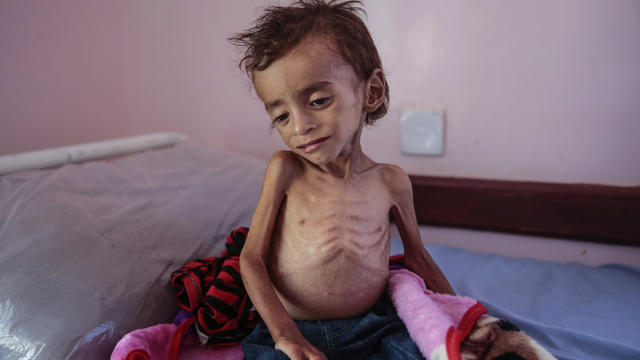 APTOPIX Yemen Displaced into Hunger Photo Essay 