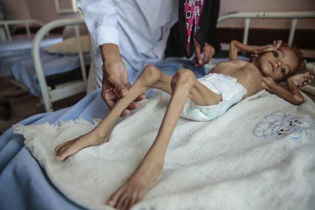 Yemen Displaced into Hunger Photo Essay 