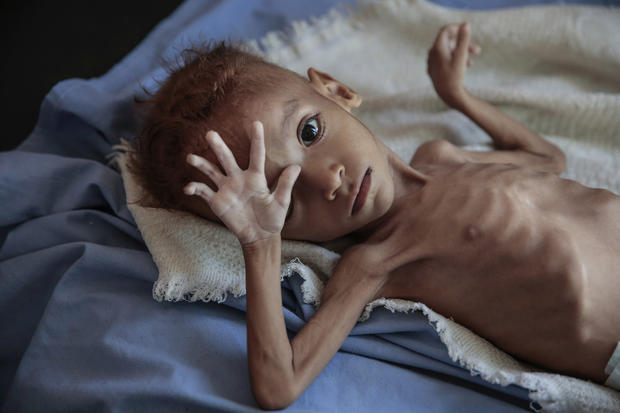 APTOPIX Yemen Displaced into Hunger Photo Essay 