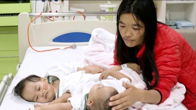 cbsn-fusion-conjoined-twins-separated-in-australia-thumbnail-1708414-640x360.jpg 