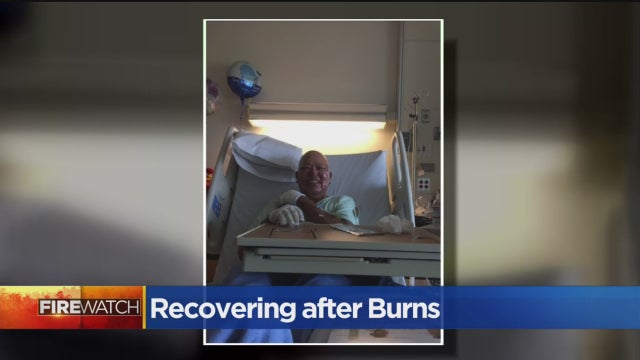 burn-victim.jpg 