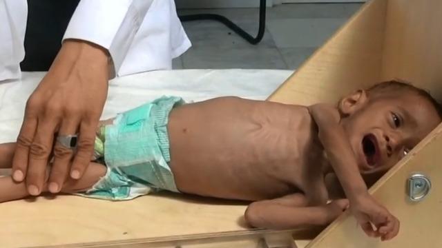 cbsn-fusion-thousands-children-died-starvation-yemen-war-save-the-children-report-today-thumbnail-1717098-640x360.jpg 