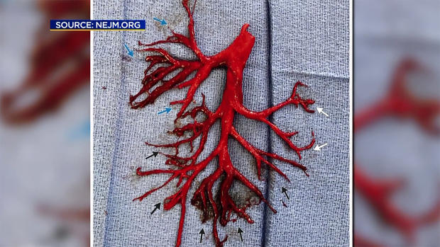 A Blood Clot Preserved Shape of Patients Right Lung 