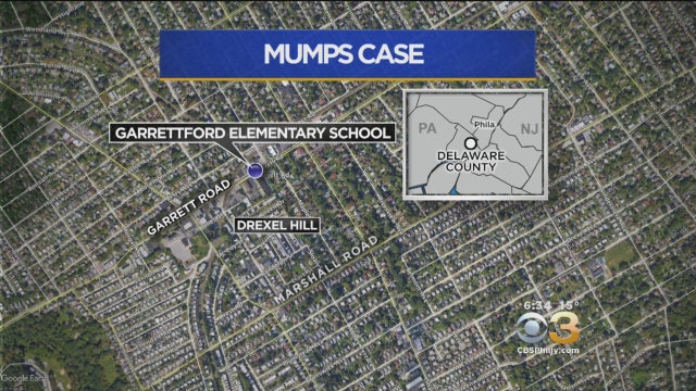 mumps-case.jpg 