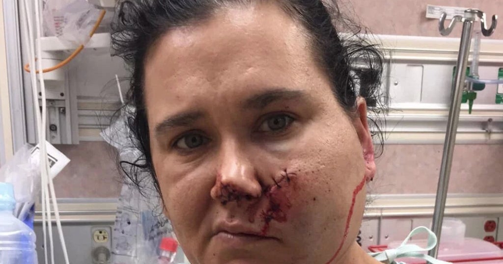 'I Was In Shock': Woman Shot In Face With Crossbow Drives Herself To ...