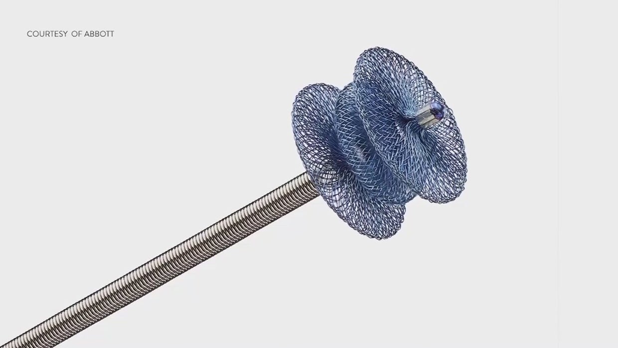 FDA Approves Device To Treat Premature Babies Born With Common Heart Defect CBS Philadelphia