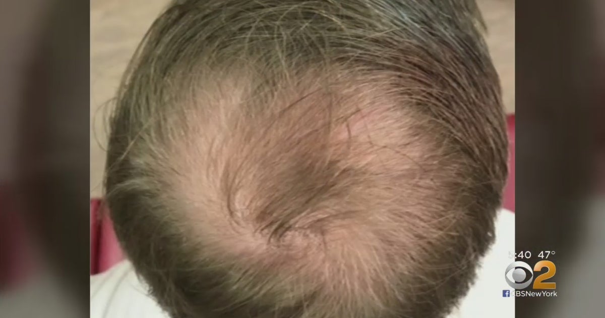 Hope For Hair Loss Patients? PRP May Help Regrowing Hair CBS New York