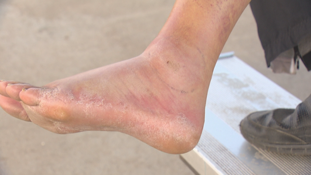 RATTLESNAKE BITE VICTIM 10PKG.transfer_frame_687 