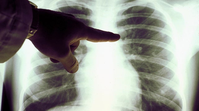 lung-x-ray.jpg 