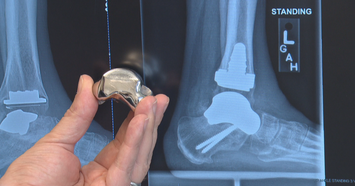 Titanium Ankle For Active 63 Year Old First For Colorado