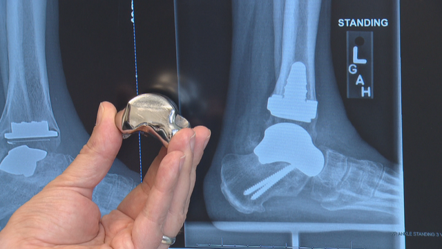 3-D ANKLE BONE 6PKG.transfer_frame_1502 