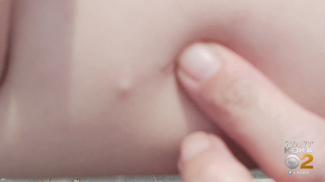 birth-control-implant.jpg 