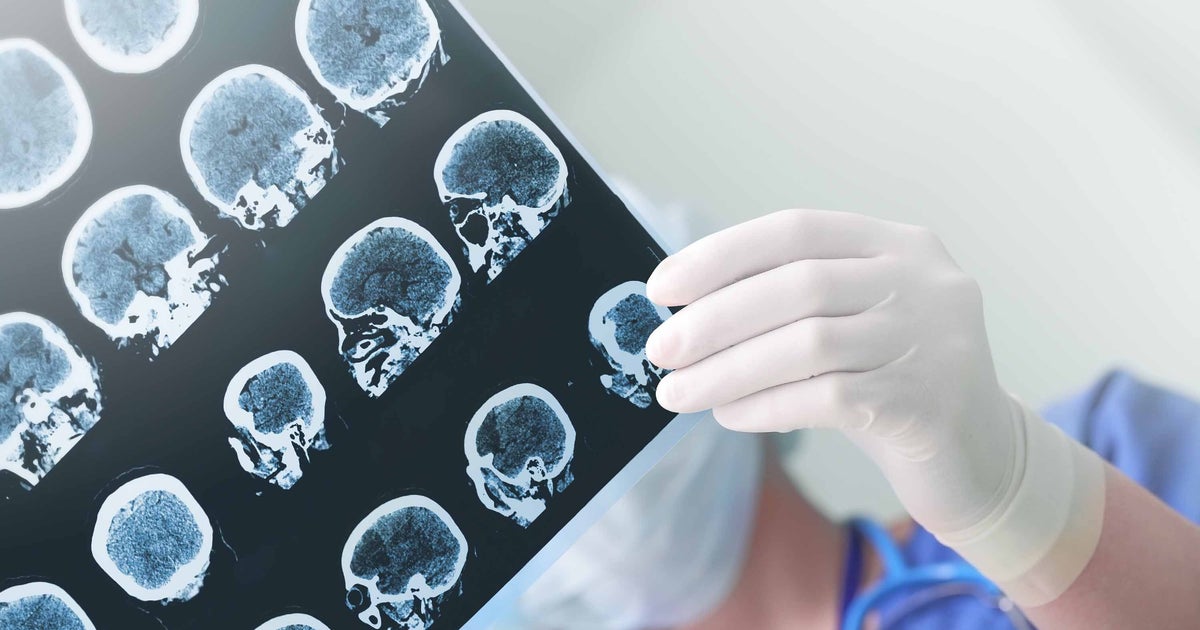 Saturday is Planet Stroke Day, understanding the warning indications can be a lifestyle saver
