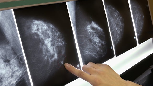cnn-do-not-reuse-mammogram.jpg 