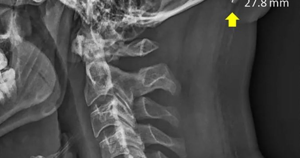 Researchers Link Smartphones To Bizarre HornLike Bumps On Young People's Skulls CBS Los Angeles