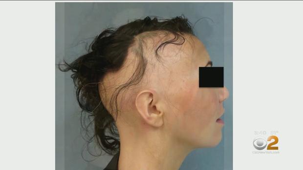 Female hair loss 