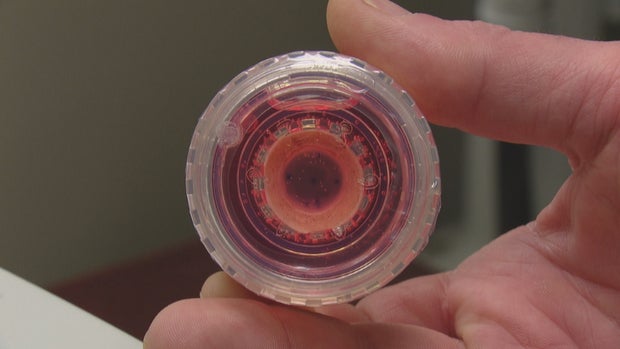 CORNEA TRANSPLANT PHOTOS 5PKG_frame_1434 