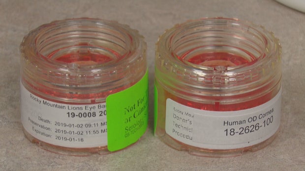 CORNEA TRANSPLANT PHOTOS 5PKG_frame_1363 