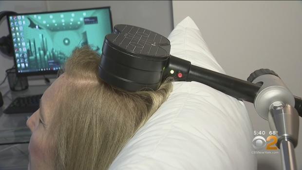transcranial magnetic stimulation, or TMS 