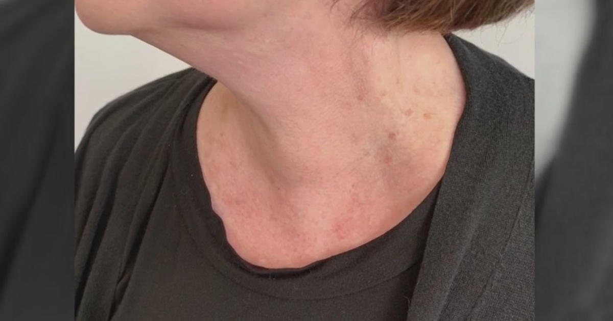 new-procedure-promised-low-risk-to-remove-thyroid-nodules-cbs-new-york