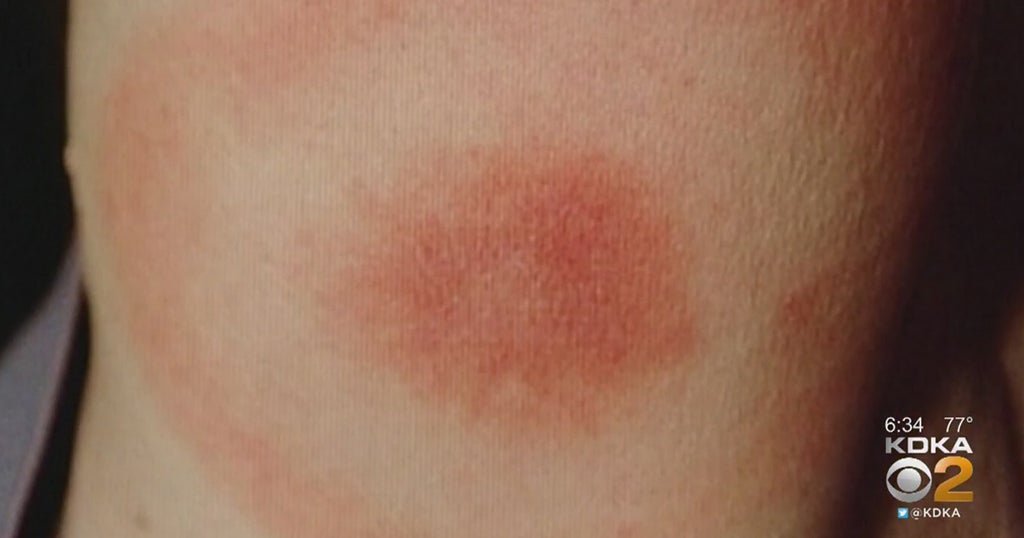 New Study Shows Lyme Disease Can Be Found In City Parks CBS Pittsburgh