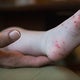 Doctors report increase in hand, foot and mouth disease among kids in western Pennsylvania 