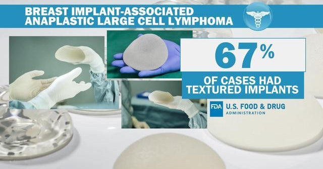 FDA proposes "black-box warning" for breast implants