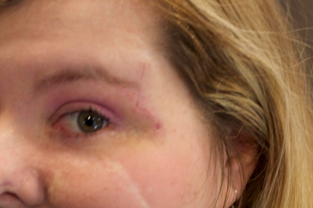 The Woman Whos Allergic To Daylight 