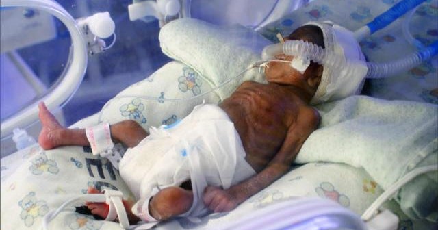 Concept of America’s high premature birth rate Concept of America’s high premature birth rate