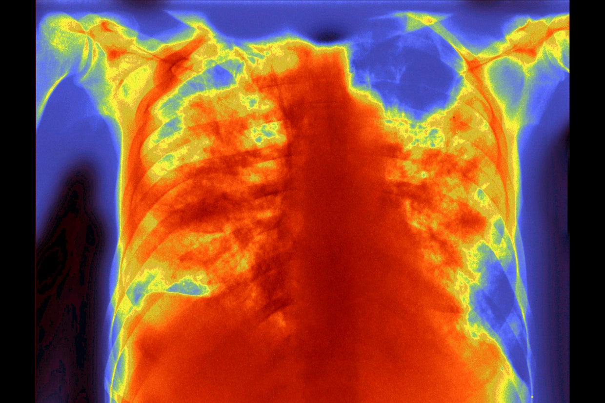 Aspergillosis 