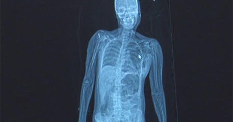 New technology, Lodox imaging system a 