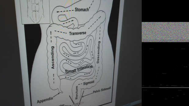 YOUNG COLON CANCER PATIENT 