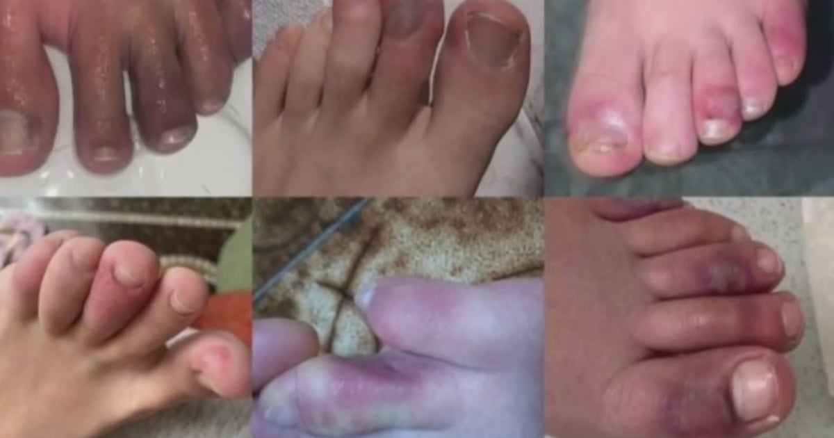 Coronavirus Update Virus May Have A New Symptom What Is 'COVID Toe' CBS San Francisco