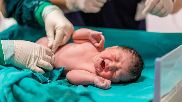 doctor cutting baby's umbilical cord 