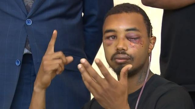 cbsn-fusion-dallas-man-hit-in-eye-police-munition-george-floyd-protest-thumbnail-494913-640x360.jpg 