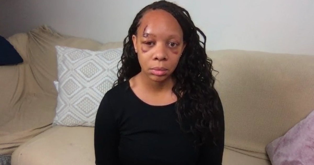 Fort Lauderdale settles lawsuit with woman shot in face with rubber bullet during protest Fort Lauderdale settles lawsuit with woman shot in face with rubber bullet during protest