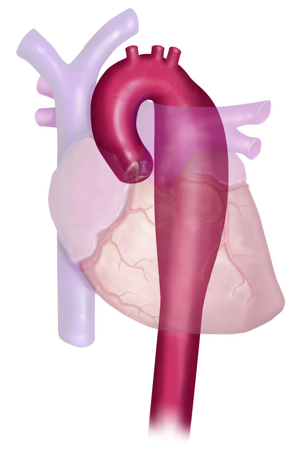 thoracic aorta repair cost 