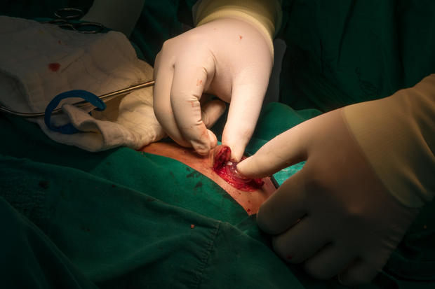 Neurosurgeon perform ventriculoperitoneal shunt for patient who had hydrocephalus 