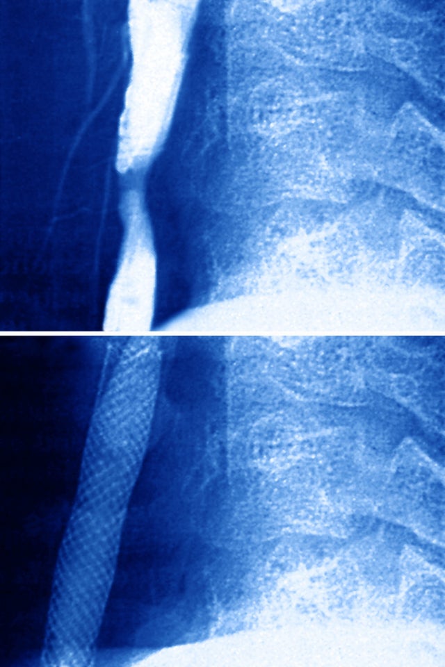 Arterial Angioplasty, Result 