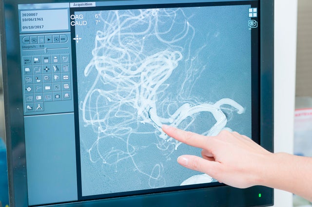 Interventional Neuroradiology 