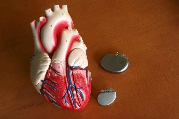 Pacemaker surgery cost 