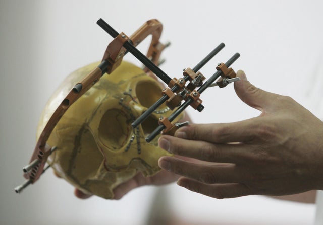 Chinese Girl With Facial Deformity Had Reconstructive Surgery 