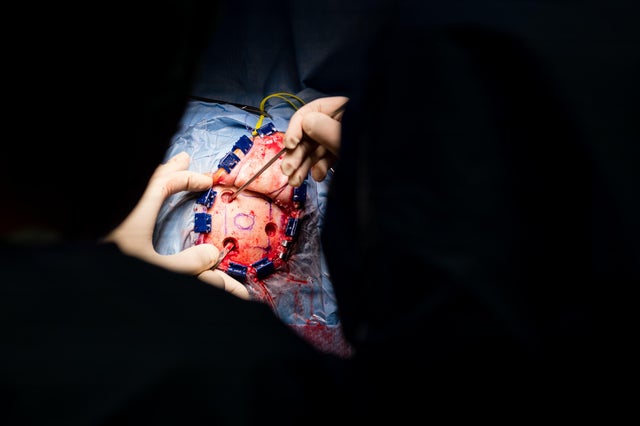 First Neurosurgery After Covid-19 Lockdown In Cremona Hospital 