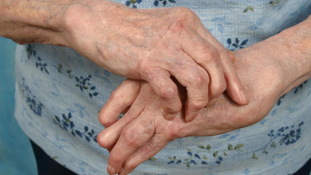 Arthritic Hands- Front, Arthritis Rheumatism 